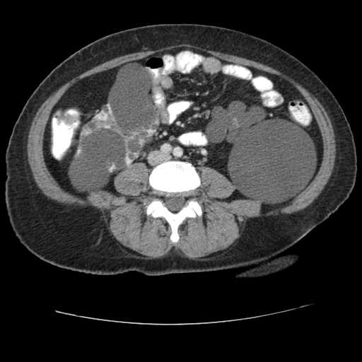File:Autosomal dominant polycystic kidney disease with hepatic involvement (Radiopaedia 32693-33662 B 50).jpg
