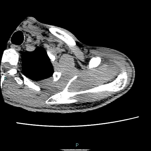 File:Avascular necrosis after fracture dislocations of the proximal humerus (Radiopaedia 88078-104653 D 22).jpg