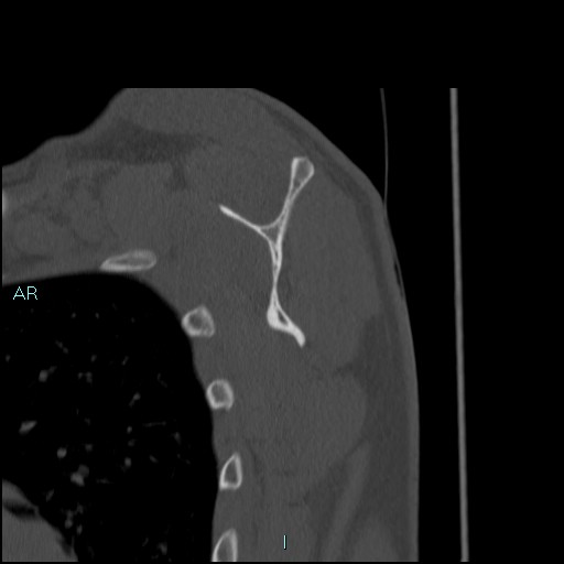 Avascular necrosis after fracture dislocations of the proximal humerus (Radiopaedia 88078-104653 Sagittal bone window 52).jpg