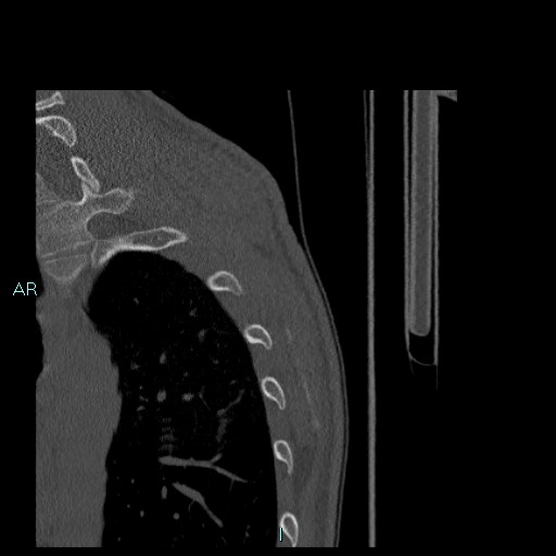 File:Avascular necrosis after fracture dislocations of the proximal humerus (Radiopaedia 88078-104655 Sagittal bone window 92).jpg
