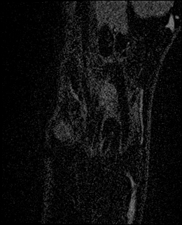 Avascular necrosis of the capitate (Radiopaedia 88317-104948 Coronal T1 vibe 8).jpg