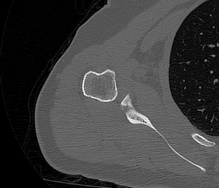 Avulsion fracture - greater tuberosity of humerus (Radiopaedia 71216-81514 Axial bone window 52).jpg