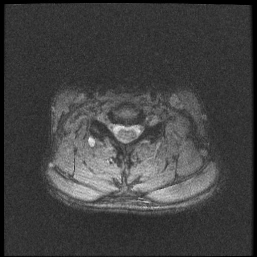 File:Axis fracture - MRI (Radiopaedia 71925-82375 Axial T2 fat sat 15).jpg
