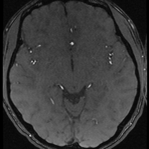 File:Azygos anterior cerebral artery (Radiopaedia 17059-16756 Axial MRA 28).jpg