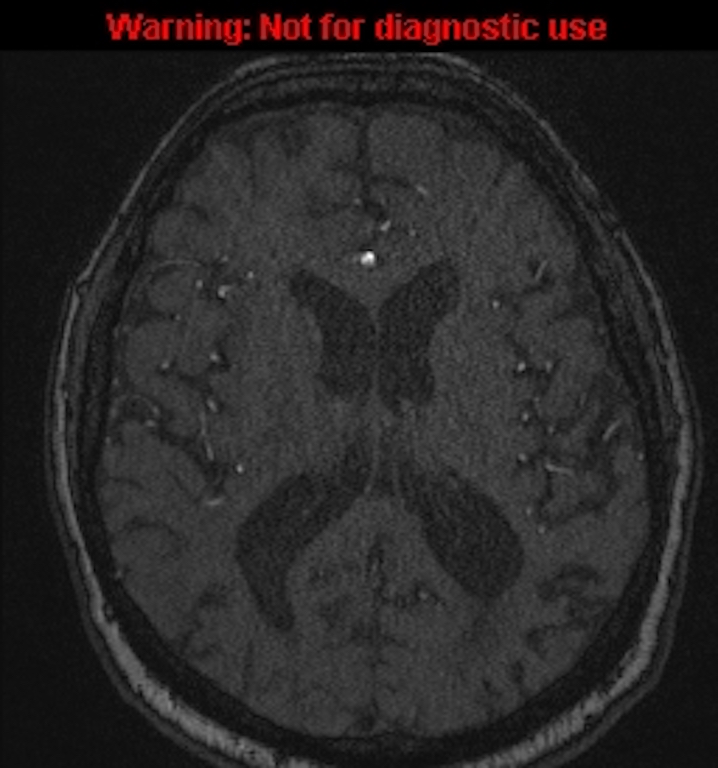 Azygos anterior cerebral artery (Radiopaedia 59325-66677 Axial MRA 101).jpg