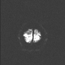 Balo concentric sclerosis (Radiopaedia 50458-55940 Axial DWI 24).jpg