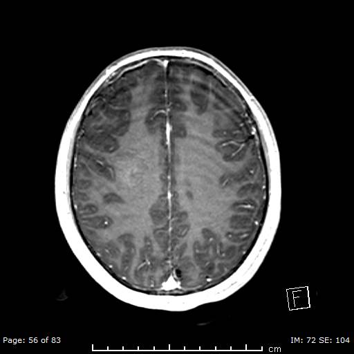 Balo concentric sclerosis (Radiopaedia 61637-69636 Axial T1 C+ 56).jpg
