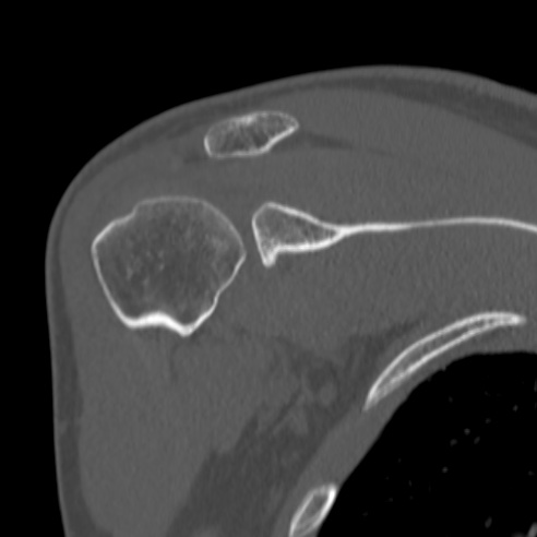 Bankart lesion (Radiopaedia 57256-64185 Coronal bone window 20).jpg