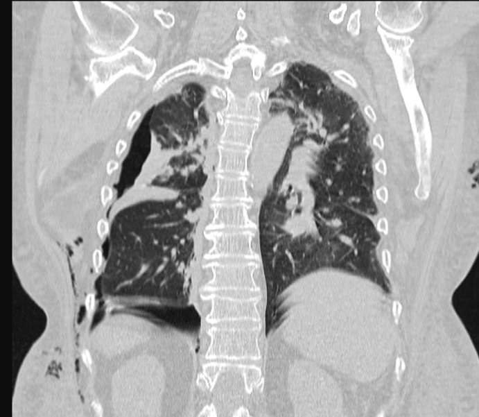 Barotrauma due to mechanical ventilation (Radiopaedia 28079-28336 Coronal lung window 68).jpg