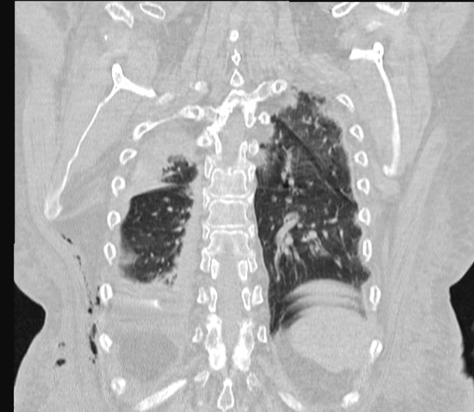 Barotrauma due to mechanical ventilation (Radiopaedia 28079-28336 Coronal lung window 74).jpg