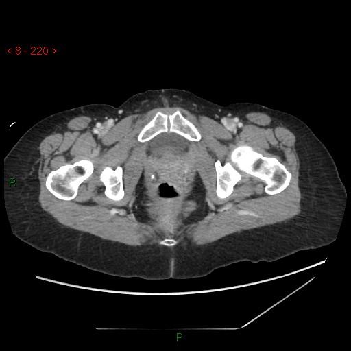 Bartholin gland cyst (Radiopaedia 54904-61181 A 55).jpg