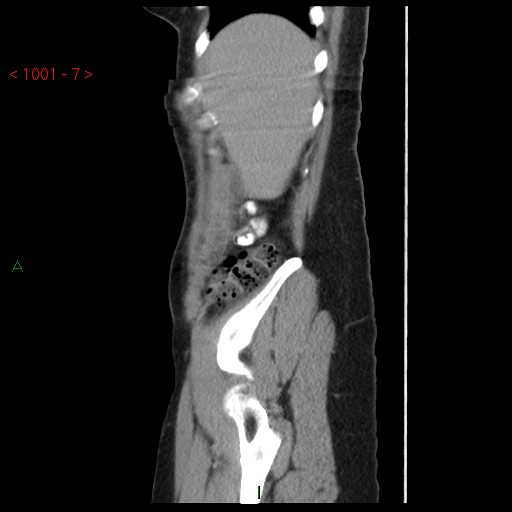 File:Bartholin gland cyst (Radiopaedia 54904-61181 Sagittal C+ delayed 7).jpg