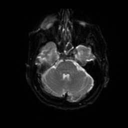 File:Basal cell carcinoma (periorbital) (Radiopaedia 55179-61559 Axial DWI 29).jpg