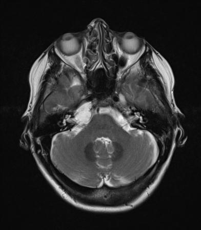 File:Base of skull chondrosarcoma (Radiopaedia 30410-31070 Axial T2 6).jpg