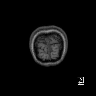 Base of skull rhabdomyosarcoma (Radiopaedia 32196-33142 Coronal T1 54).jpg