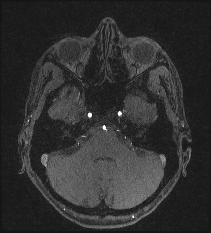Basilar artery perforator aneurysm (Radiopaedia 82455-97733 Axial MRA 64).jpg