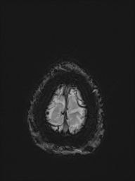 Basilar artery perforator aneurysm (Radiopaedia 82455-97733 Axial SWI 60).jpg