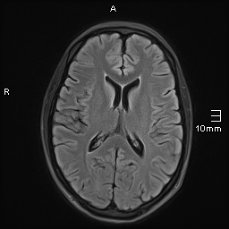 File:Basilar artery perforator aneurysm (Radiopaedia 82455-99523 Axial FLAIR 13).jpg