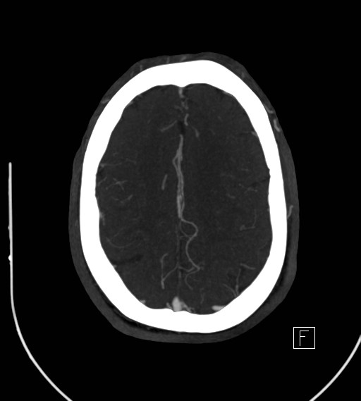 File:Basilar artery thrombosis (Radiopaedia 26986-27163 A 65).jpg