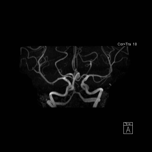 Basilar tip aneurysm (Radiopaedia 26504-26632 D 1).jpg