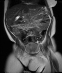 File:Beckwith-Wiedeman syndrome with bilateral Wilms tumors (Radiopaedia 60850-69233 Coronal T2 8).jpg