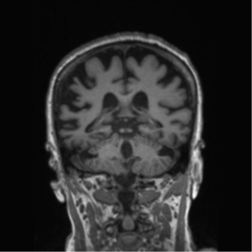 File:Behavioral variant frontotemporal dementia and late onset schizophrenia (Radiopaedia 52197-58083 Coronal T1 39).png