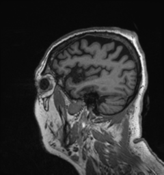 Behavioral variant frontotemporal dementia and late onset schizophrenia (Radiopaedia 52197-58083 Sagittal T1 86).png
