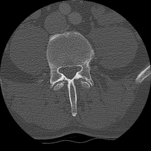 Benign post-traumatic pseudopneumoperitoneum (Radiopaedia 71199-81495 Axial bone window 254).jpg