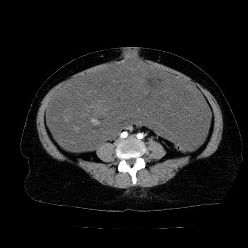 Benign spindle cell tumor - abdominopelvic (Radiopaedia 61300-69212 A 39).jpg
