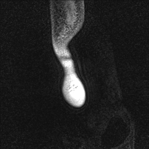 Bilateral Achilles tendon complete tear (Radiopaedia 81344-95051 Sagittal WE - Left 109).jpg