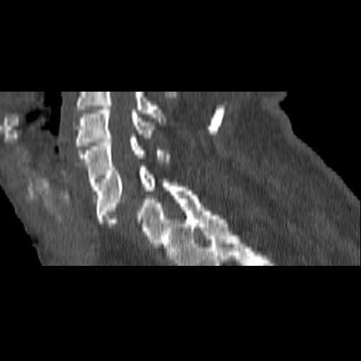 File:Bilateral C6-7 locked facet dislocation (Radiopaedia 28506-28748 Sagittal bone window 7).jpeg