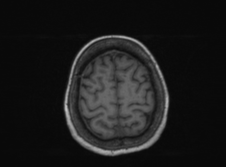 Bilateral PCA territory infarction - different ages (Radiopaedia 46200-51784 Axial T1 148).jpg