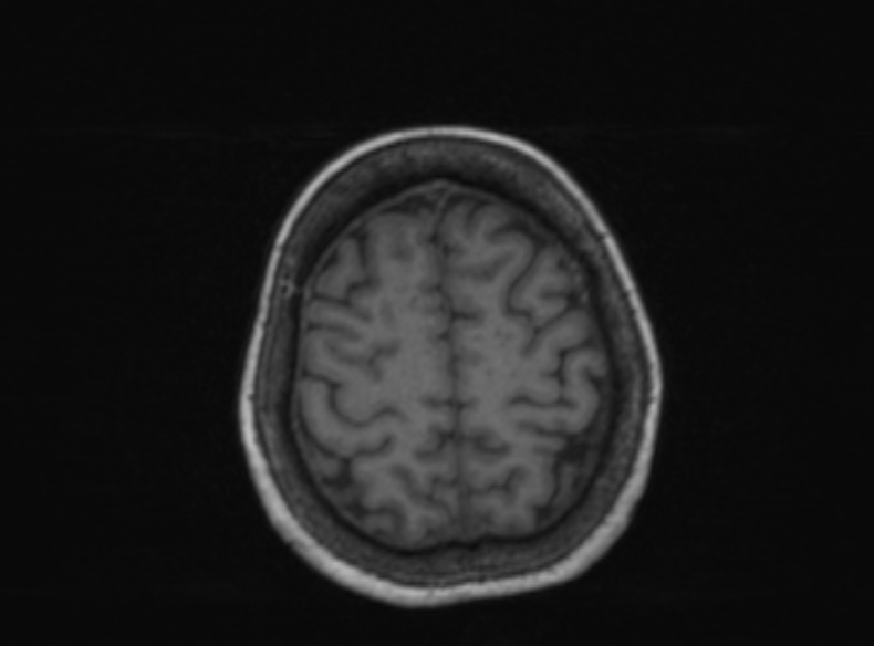 Bilateral PCA territory infarction - different ages (Radiopaedia 46200-51784 Axial T1 154).jpg