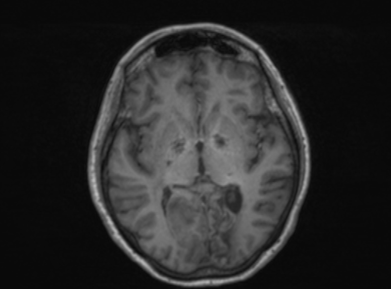 File:Bilateral PCA territory infarction - different ages (Radiopaedia 46200-51784 Axial T1 240).jpg