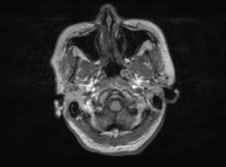 File:Bilateral PCA territory infarction - different ages (Radiopaedia 46200-51784 Axial T1 345).jpg