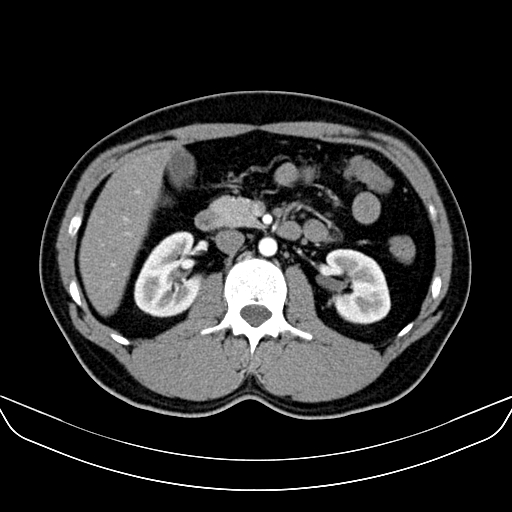 Bilateral accessory renal arteries with mild pelvi-ureteric junction (PUJ) obstruction (Radiopaedia 66357-75596 A 23).jpg
