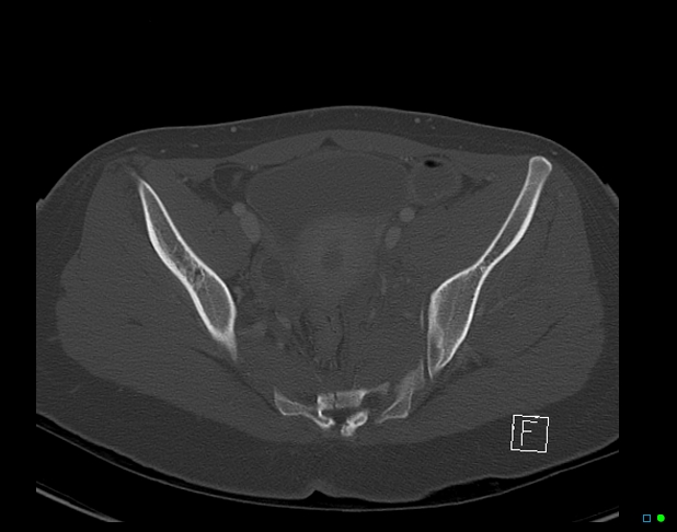 File:Bilateral acetabular fractures (Radiopaedia 79272-92308 Axial bone window 30).jpg