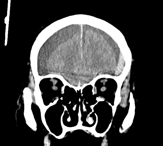 Bilateral acute on chronic subdural hematomas (Radiopaedia 78466-91146 Coronal non-contrast 18).jpg