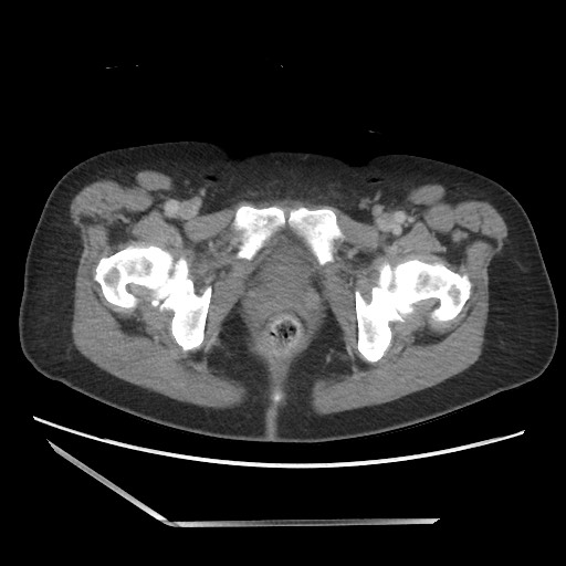 File:Bilateral adrenal granulocytic sarcomas (chloromas) (Radiopaedia 78375-91007 Axial 100).jpg
