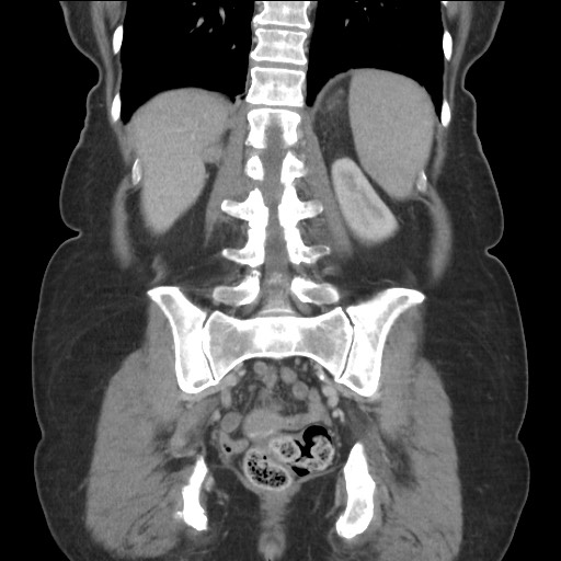 Bilateral adrenal granulocytic sarcomas (chloromas) (Radiopaedia 78375-91007 B 68).jpg