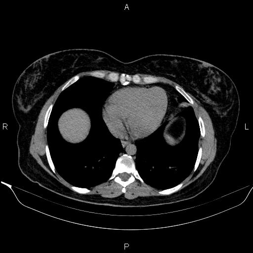 Bilateral adrenal myelolipoma (Radiopaedia 63058-71535 Axial non-contrast 3).jpg
