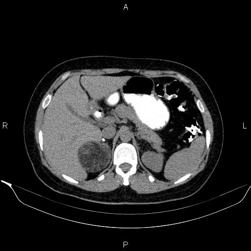 File:Bilateral adrenal myelolipoma (Radiopaedia 63058-71535 Axial non-contrast 45).jpg