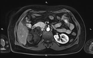 Bilateral adrenal myelolipoma (Radiopaedia 63058-71537 Axial T1 C+ fat sat 42).jpg