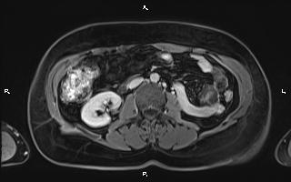 File:Bilateral adrenal myelolipoma (Radiopaedia 63058-71537 H 58).jpg