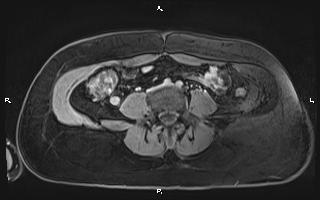 Bilateral adrenal myelolipoma (Radiopaedia 63058-71537 H 75).jpg