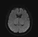 File:Bilateral and symmetric thalamic glioma (Radiopaedia 66119-75289 Axial DWI 13).jpg