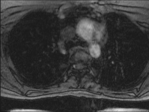 Bilateral carotid body tumors and right glomus jugulare tumor (Radiopaedia 20024-20060 Axial MRA 144).jpg