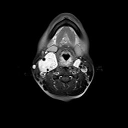 File:Bilateral carotid body tumors and right jugular paraganglioma (Radiopaedia 20024-20060 Axial 91).jpg