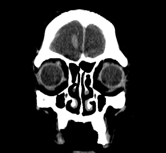 Bilateral ectopia lentis (Radiopaedia 89889-107013 Coronal non-contrast 26).jpg