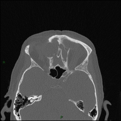 Bilateral frontal mucoceles (Radiopaedia 82352-96454 Axial bone window 125).jpg